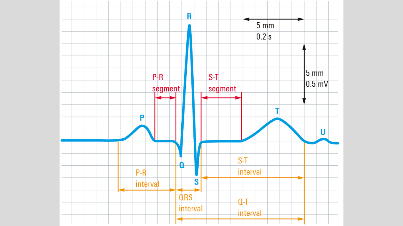 ECG 信号（来自引线 1）