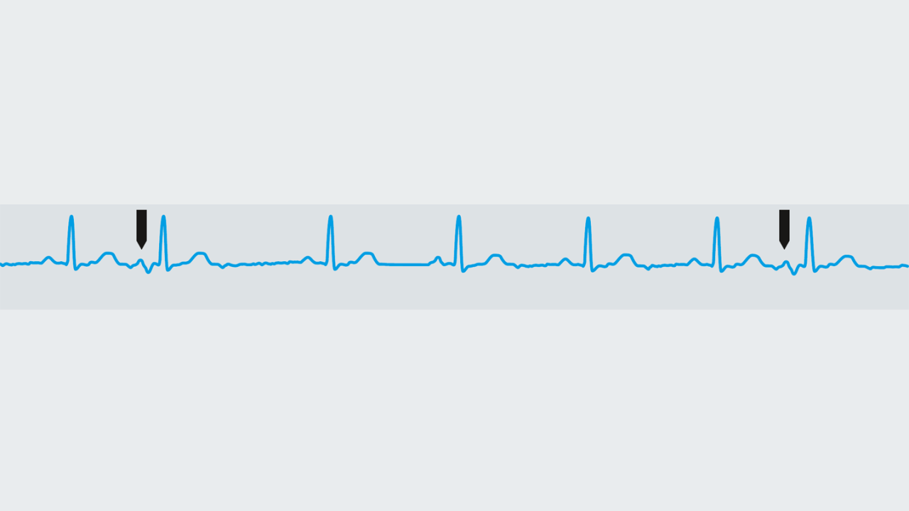 周期性 ECG 信号中的非周期性干扰